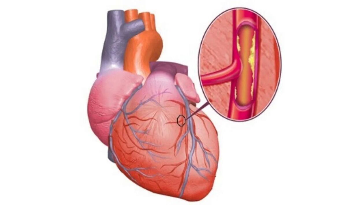 Heart problems due to high blood pressure. 