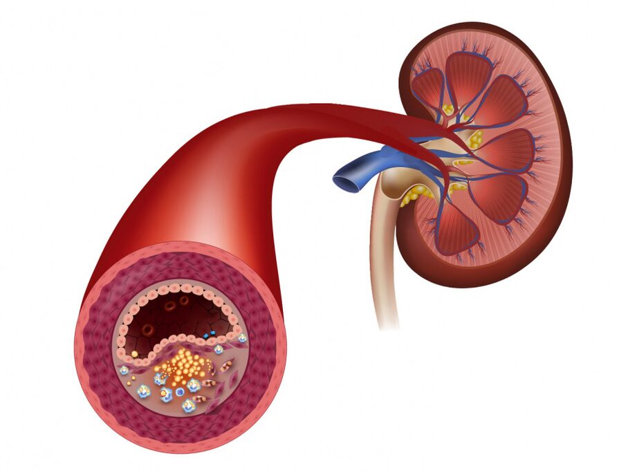 Blood flow reduction due to atherosclerosis